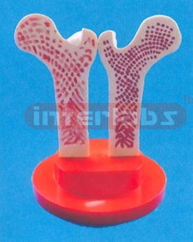 GIANT FEMUR HEAD SHOWING OSTEOPOROSIS THE HEAD AND UPPER END OF AN ADU L T FEMUR DIVIDED LONGITUDINALLY AND HINGED.ONE HALF IS NORMAL, THE OTHER SHOWS THE EFFECTS OF OSTEOPOROSIS ON THE SURFACE AND ST